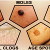 images of cancerous skin tags